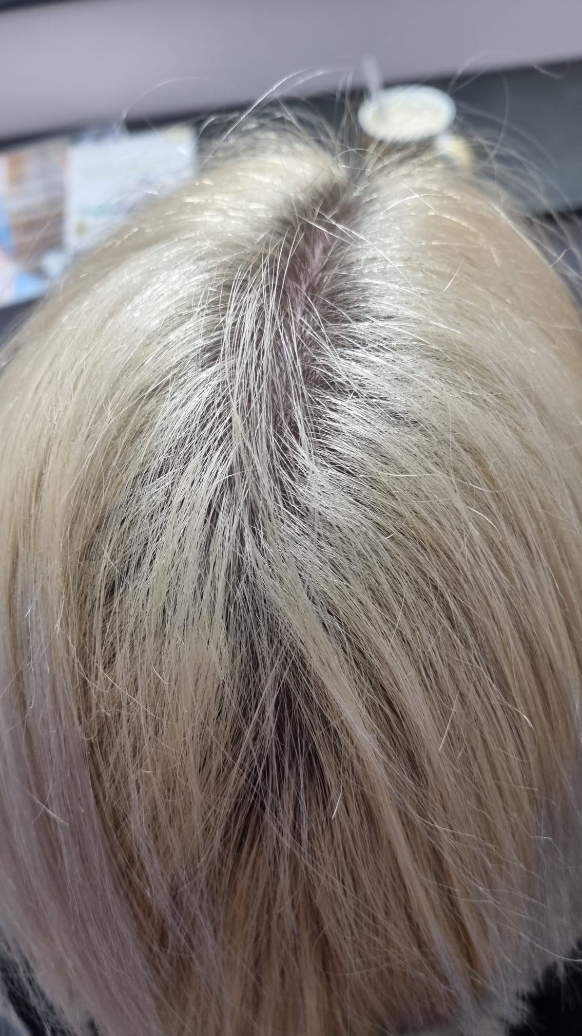 Botox Platinum Bielefeld Vorher